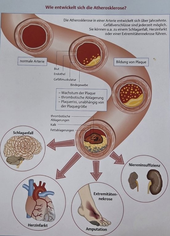Atherosklerose - GSK Venenzentrum Königstein im Taunus