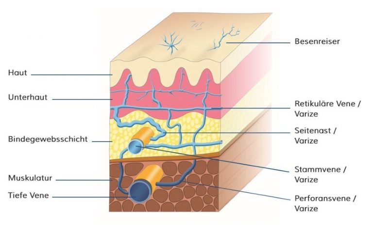 Entwicklung von Krampfadern - GSK Venenzentrum Königstein im Taunus