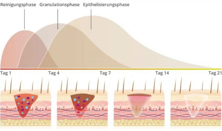 Wundheilungsphasen - GSK Venenzentrum Königstein im Taunus